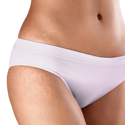 Thalassa - Stretch marks