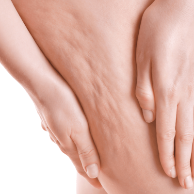 Thalassa - Cellulitis